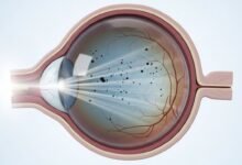 هل ذبابة العين خطيرة